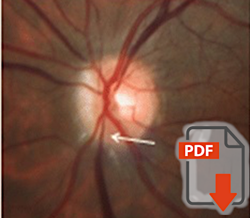Retinal venous pressure: the role of endothelin