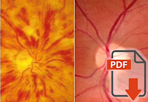 Retinal venous pressure in the non-affected eye of patients with retinal vein occlusions